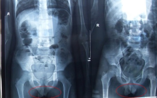 腹部立卧位X光片图