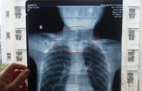 胸部正位X光片图